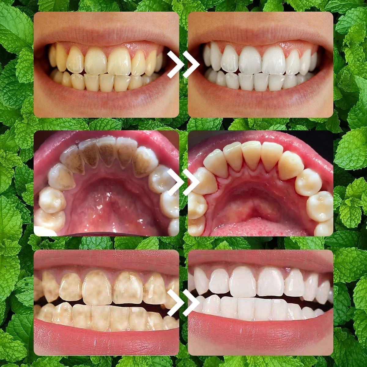 🔥 Oralhoo Teeth Restoration Mineral Powder – مسحوق ترميم الأسنان أورالهو