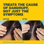 🔥Nizoral® 2% Anti-Dandruff Shampoo Original – شامبو نيزورال الأصلي للقشرة