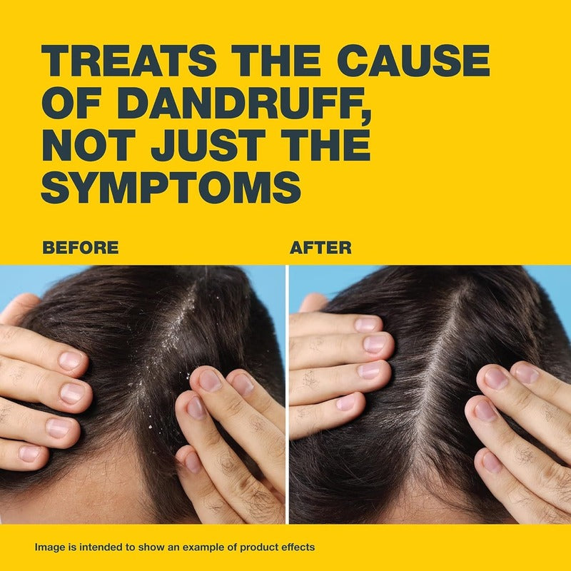 🔥Nizoral® 2% Anti-Dandruff Shampoo Original – شامبو نيزورال الأصلي للقشرة