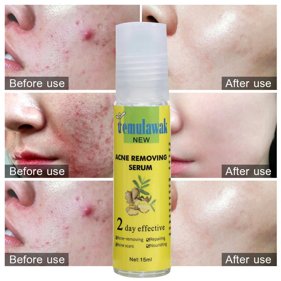 🔥 Temulawak New Acne Removing Serum – سيروم تمولاواك لازالة حبّ الشباب